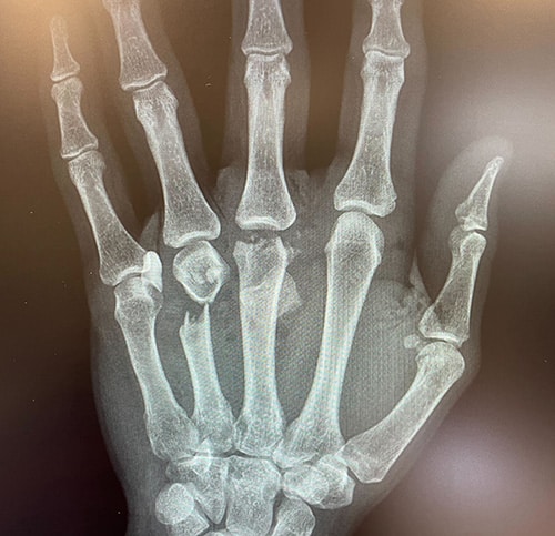 X-ray of dog owner's hand showing fractures gained from trying to break up a dog attack fight